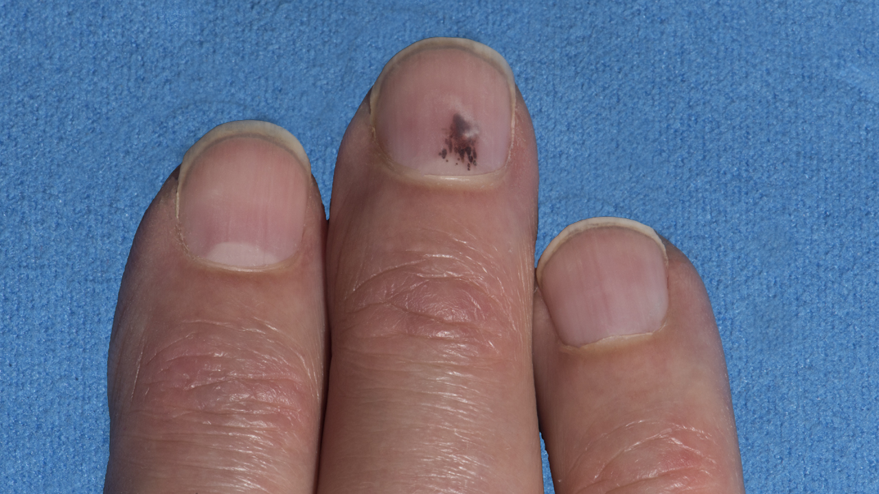 Black Line Under Nail Melanoma