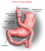 Gastric Bypass Image