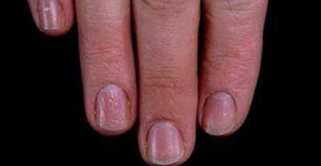 fingernail ridges