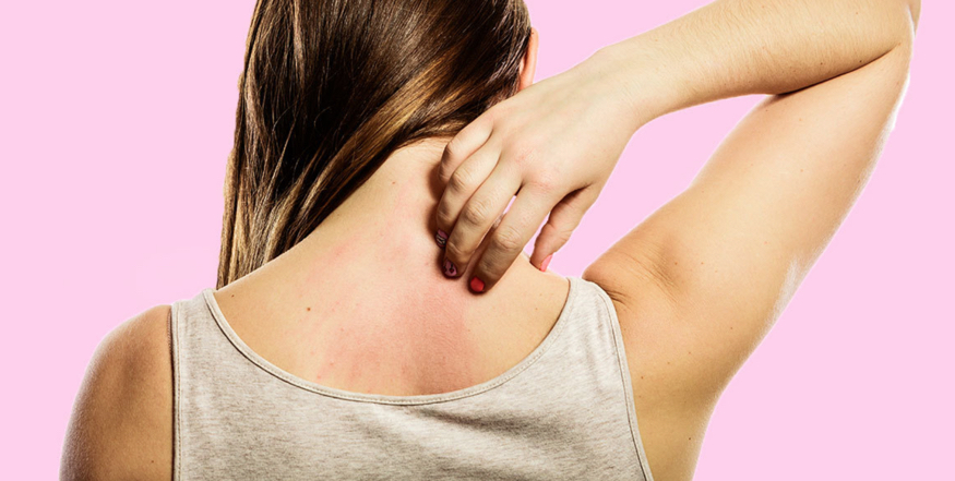 Eczema - That Itchy, Scratchy, Scaly Stuff