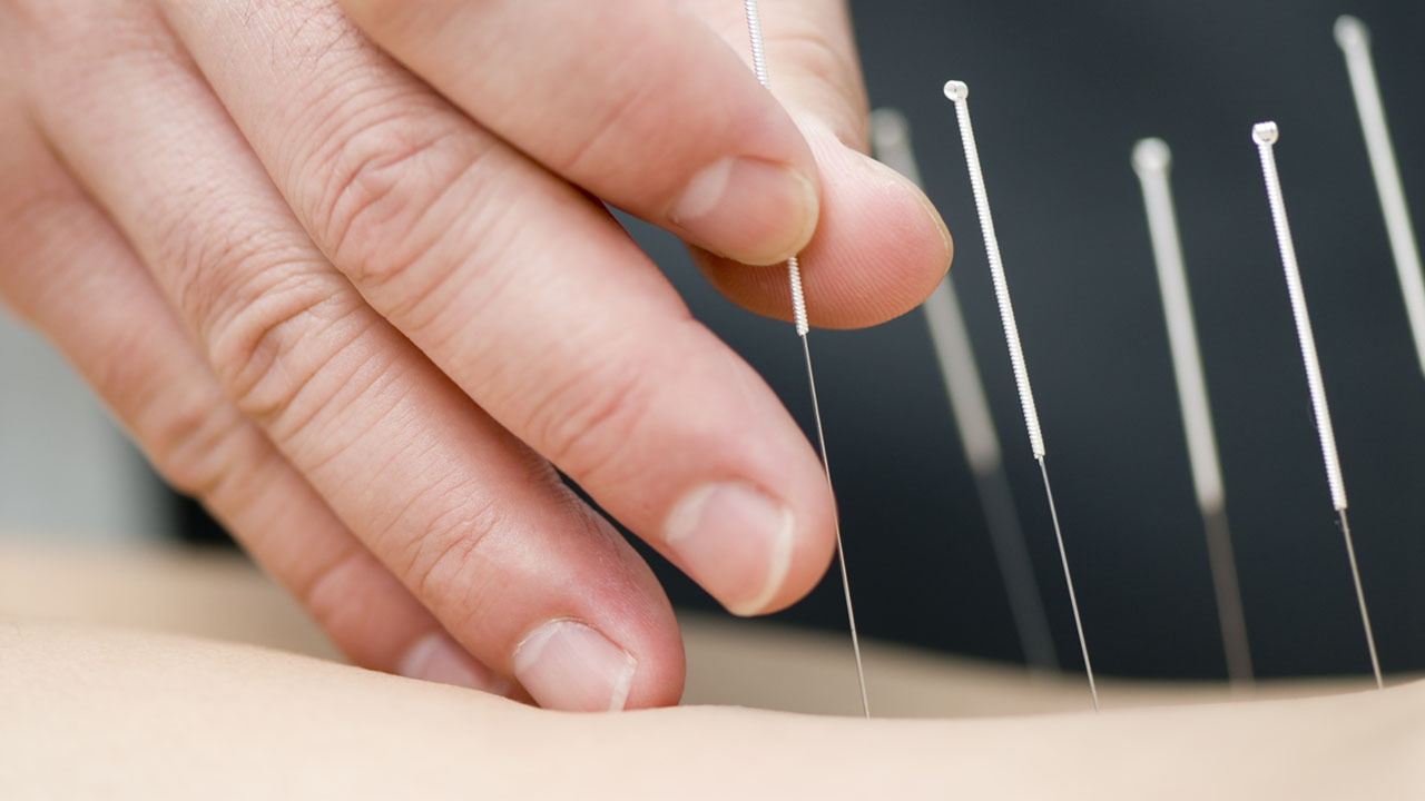 Acupuncture needle application