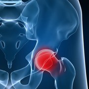 joint replacement due to osteoarthritis with Dr. Patel and Jane Linnell