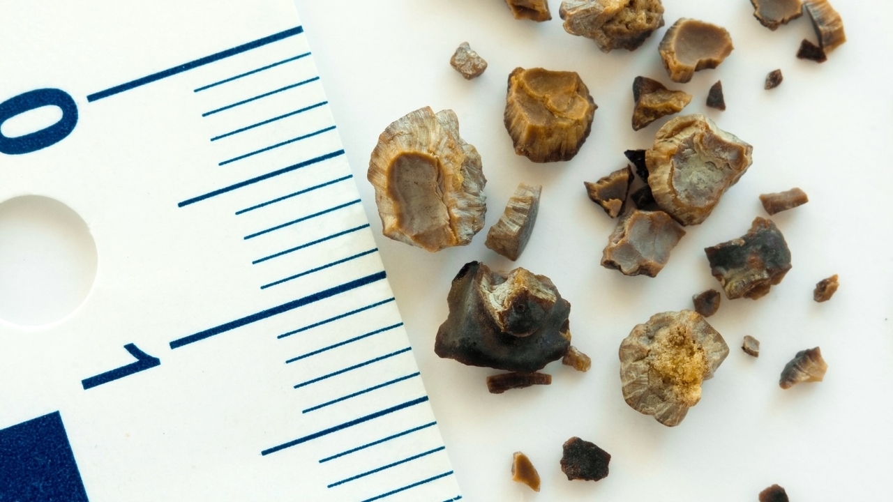 What Are Kidney Stones? How Do You Get Rid of Them?