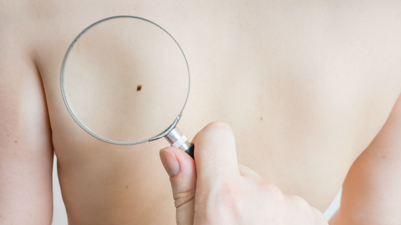 Itchy Mole?  Some Cases of Skin Cancer May Itch
