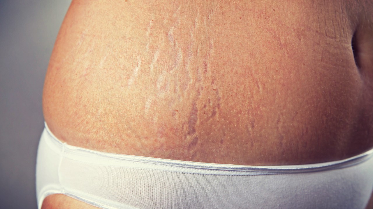 How You Can Combat Stretch Marks During and After Pregnancy